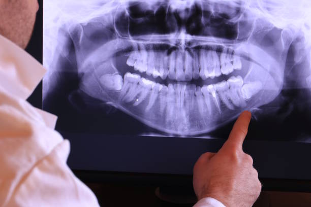 Best Emergency Wisdom Tooth Extraction in High Rolls, NM